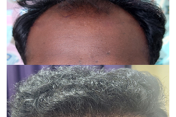 Hairline Before After Hairline Before After