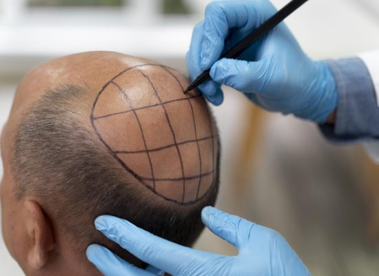 hair transplant clinic mogappair